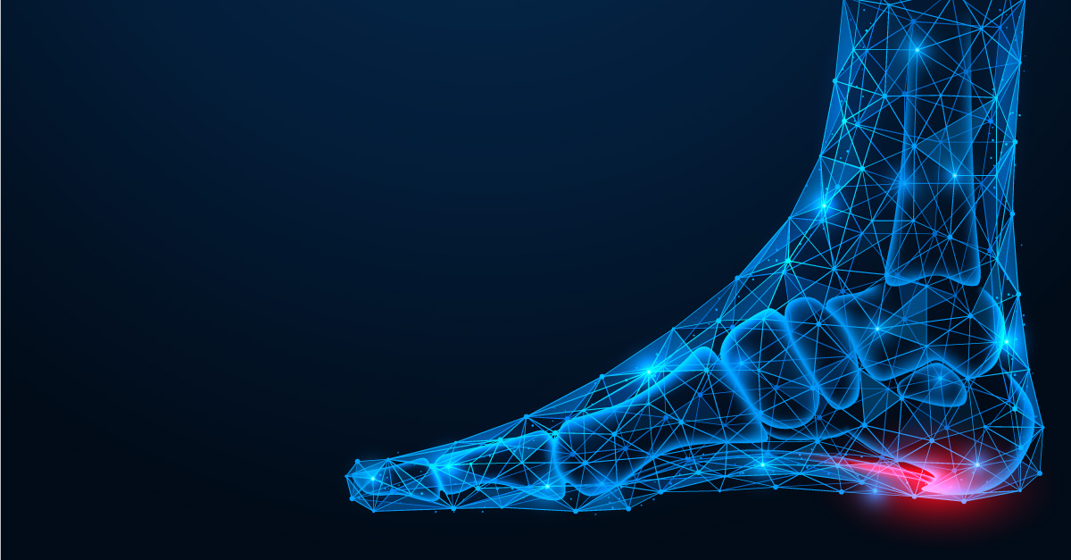 3d illustration of foot pain caused by plantar fasciitis