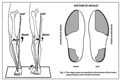 Outside Arch Support