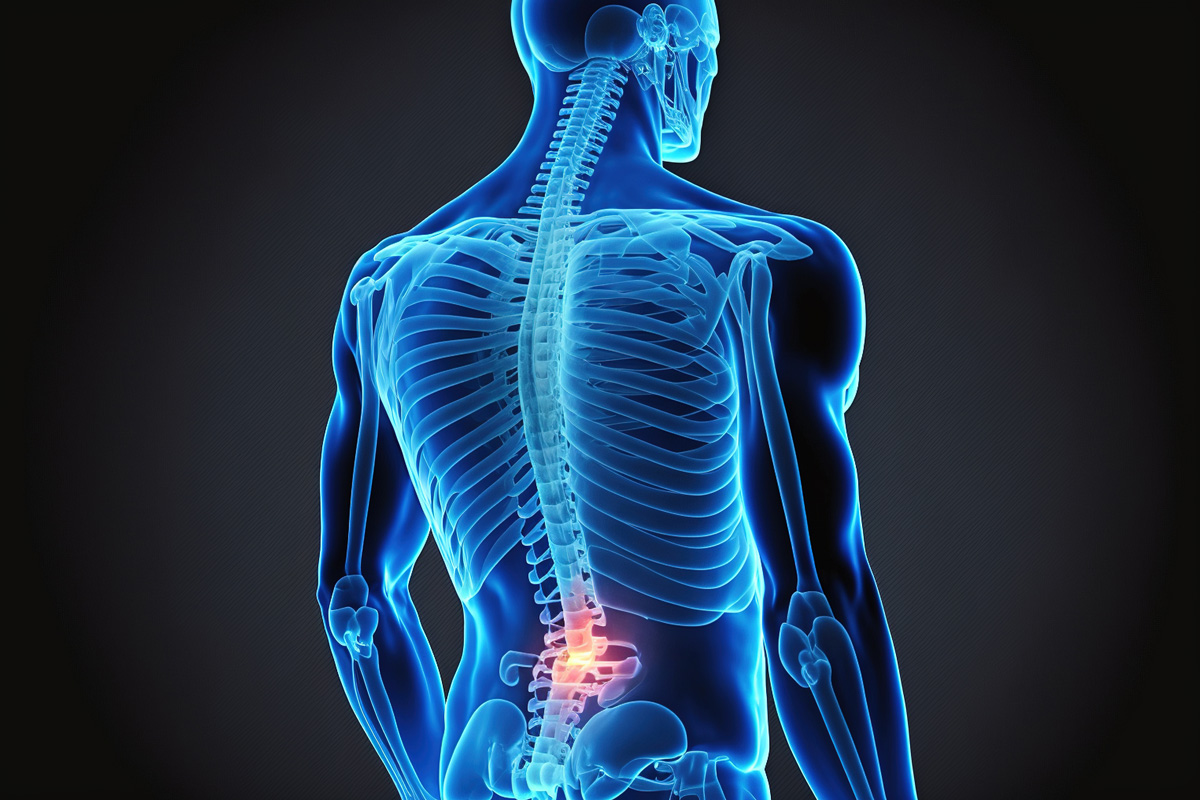 sciatica nerve pain shown on a 3d skeleton overlay