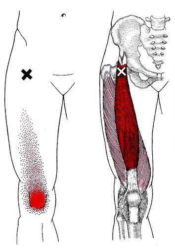 psoas pain referral pattern