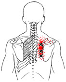 trigger points rhomboids