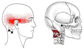 suboccipital trigger point referral