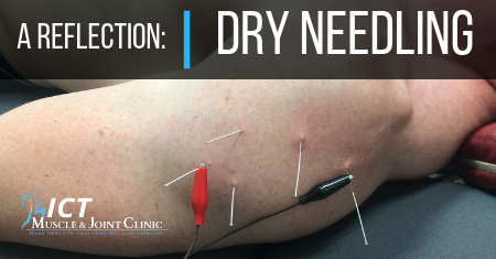 FB-A-Reflection-Dry-Needling
