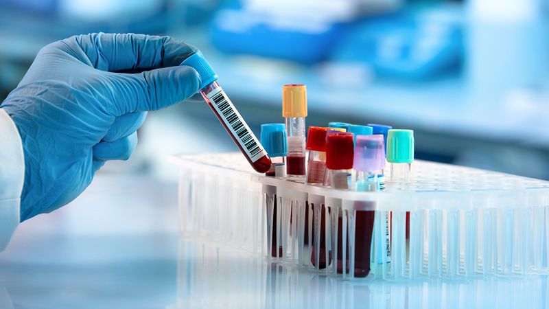 lactate stress testing lab bloodwork